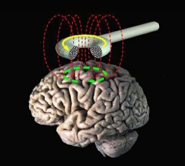 Tratamento com estimulação magnética transcraniana para depressão